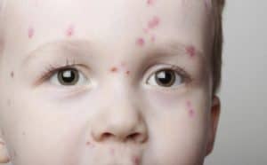 Rêver de maladie de peau.