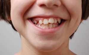 Pourquoi rêver de dents tordues?