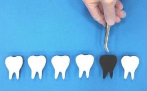 Rêver de perdre des dents noires