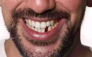 Pourquoi rêver de perdre une carie?