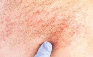 Pourquoi rêver d'eczéma ?