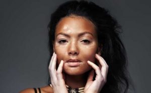 Pourquoi rêver de vitiligo ?