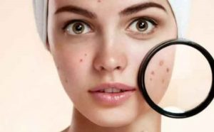 Pourquoi rêver d'avoir de l'acné sur le visage ?