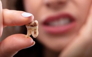 Pourquoi rêver de dent pourrie?