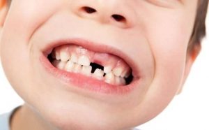 Pourquoi rêver de dents de lait ?