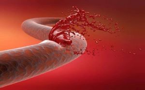 Pourquoi rêver d'hémorragie ?