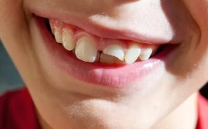 Pourquoi rêver d'une dent de devant cassée ?