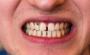 Pourquoi rêver de nourriture dans les dents ?