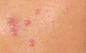 Pourquoi rêver de pustules ?